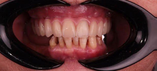 teeth after