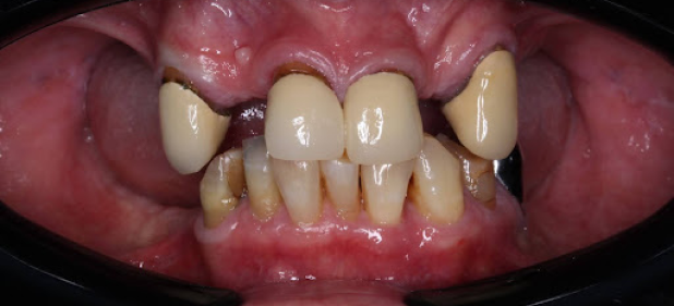 teeth before