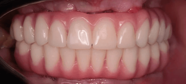 teeth after
