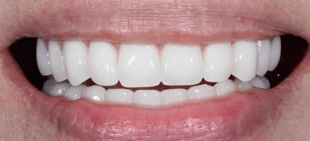 teeth after