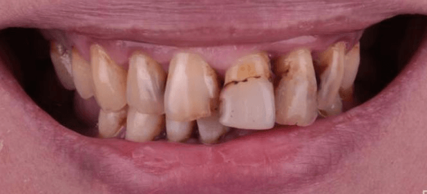 teeth before
