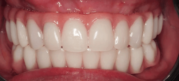 teeth after