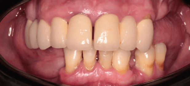 teeth before