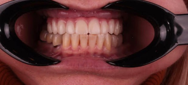 teeth after