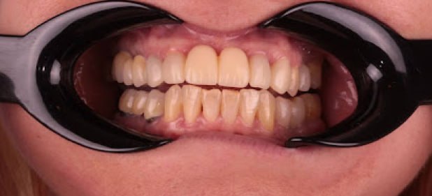 teeth before