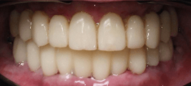 teeth after
