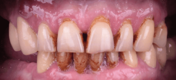 teeth before